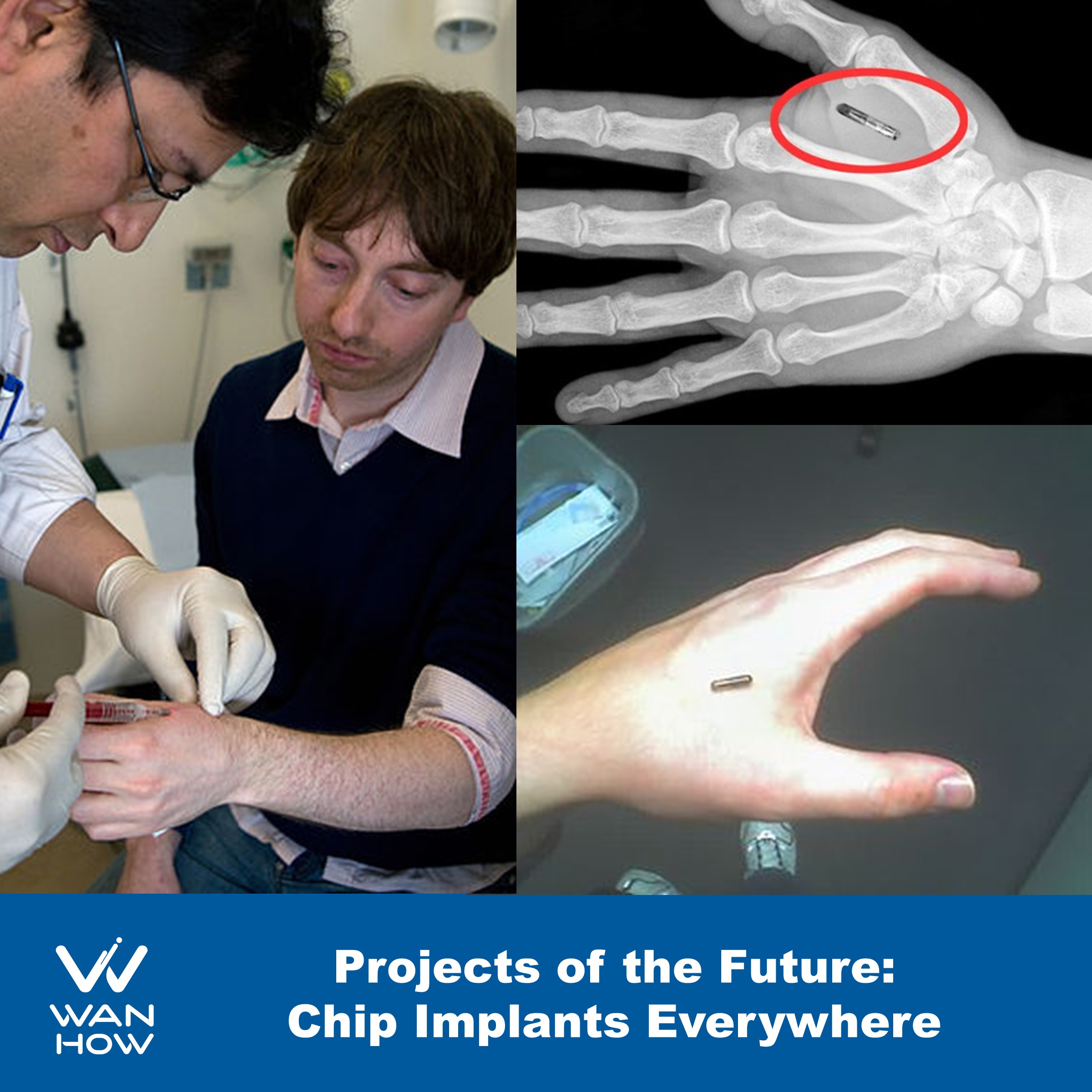 Projects of the Future: Chip Implants Everywhere